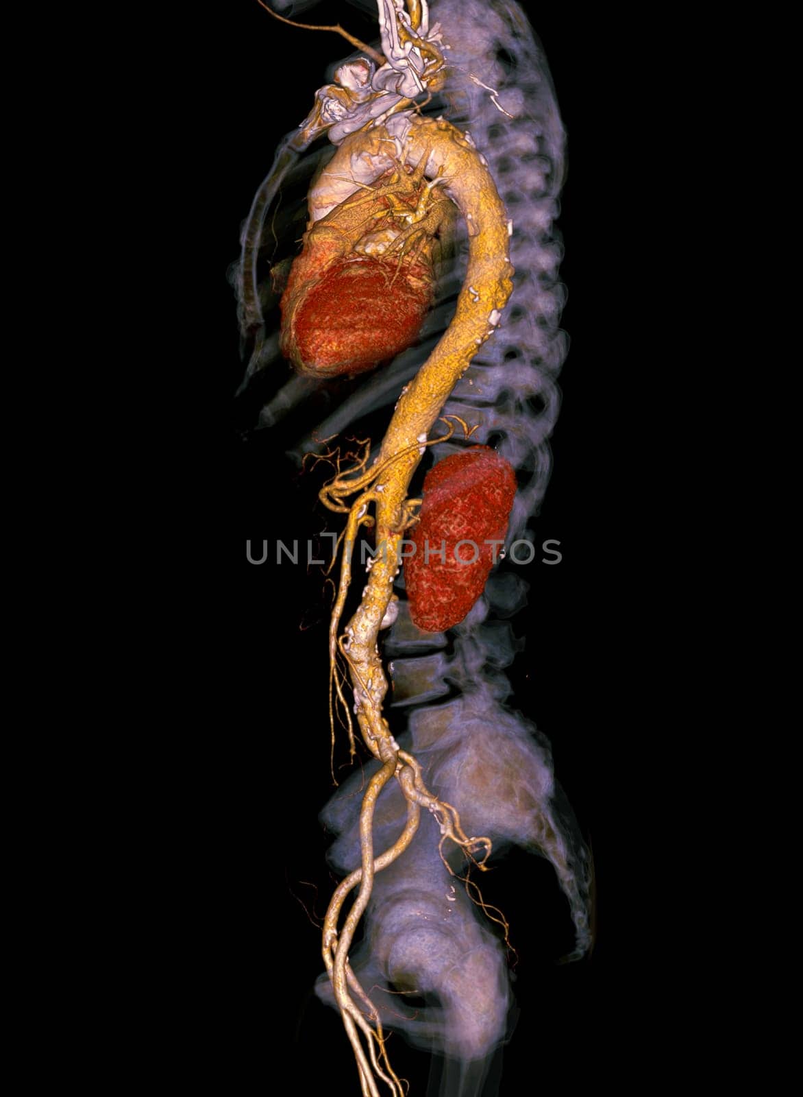 CTA whole aorta 3D rendering.