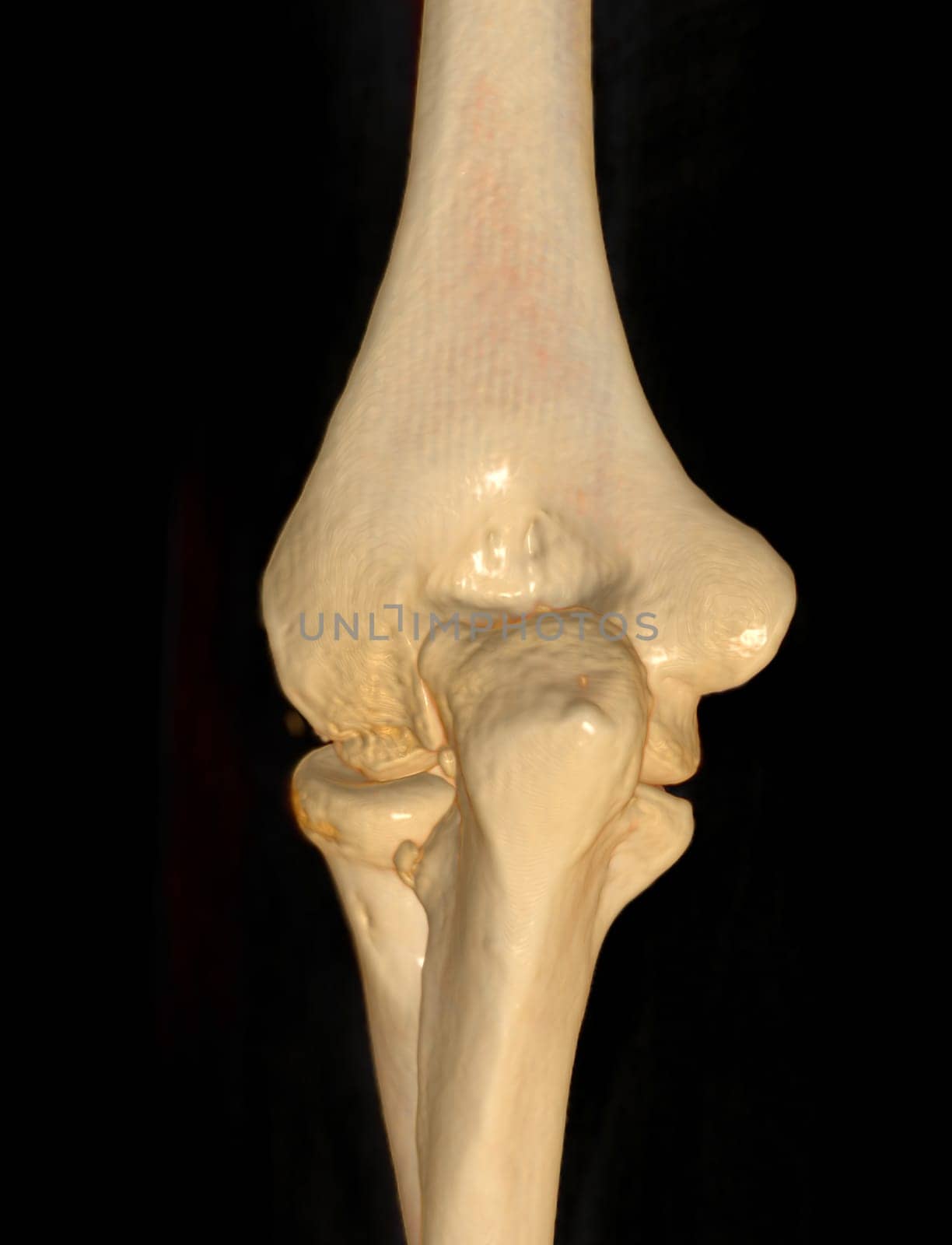 CT scan of elbow joint 3d rendering .