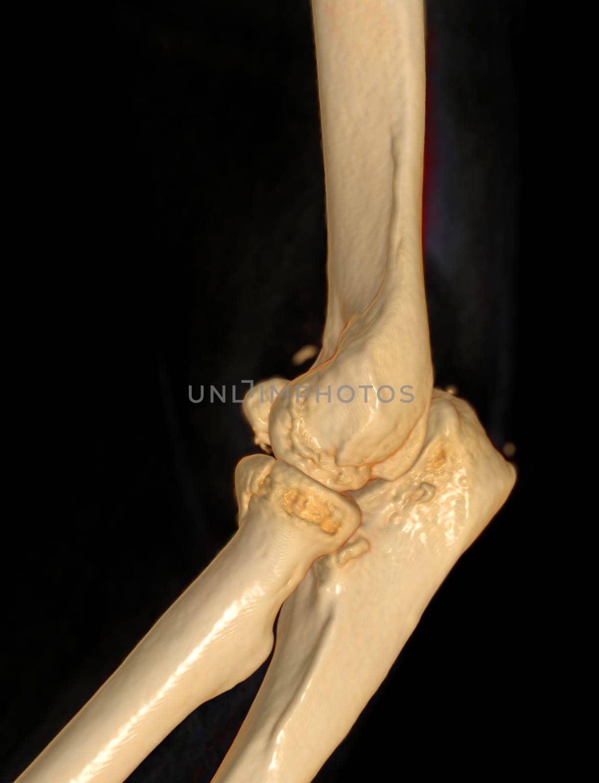 CT scan of elbow joint 3d rendering . by samunella