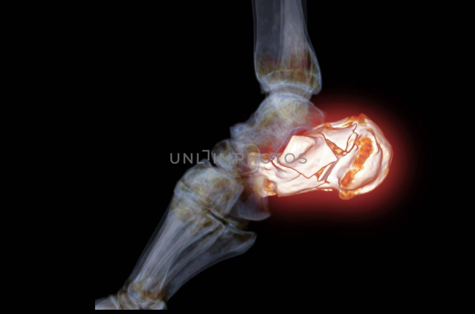 CT Scan ankle joint with  3d rendering of calcaneus bone showing Calcaneus (Heel Bone) Fractures. by samunella