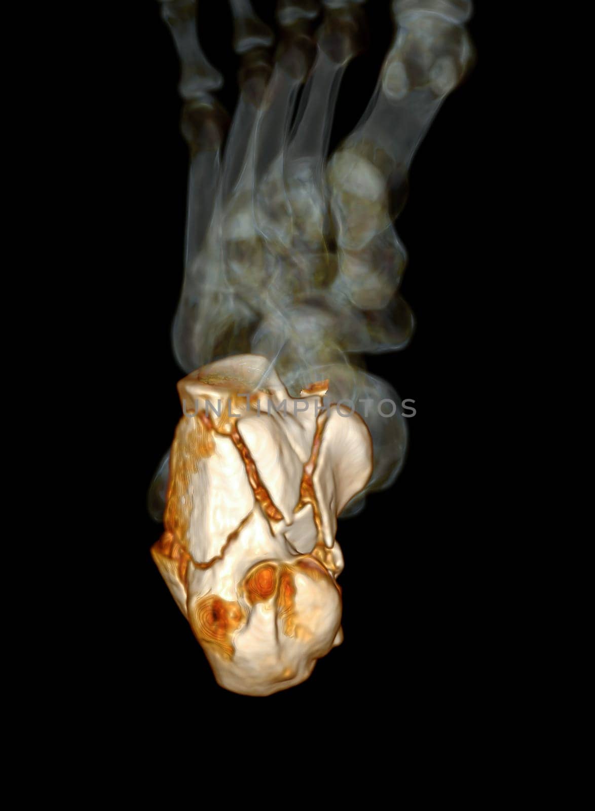 CT Scan ankle joint with  3d rendering of calcaneus bone showing Calcaneus (Heel Bone) Fractures.
