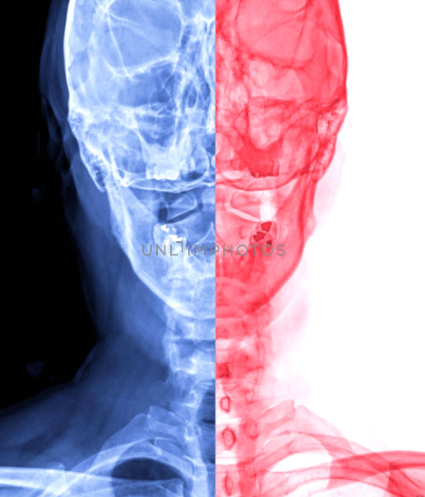 X-ray C-spine or x-ray image of Cervical spine open mount  view for  fracture of cervical vertebra 2nd ( axis ).