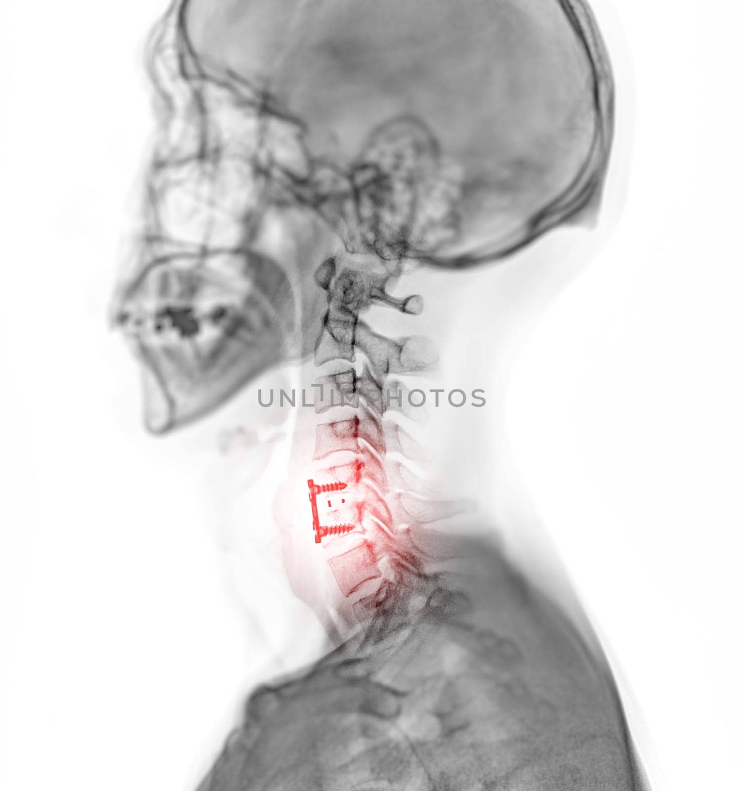 X-ray C-spine or x-ray image of Cervical spine lateral view showing fixed screw. by samunella