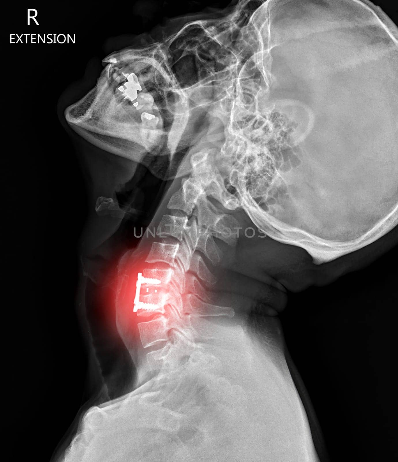 X-ray C-spine or x-ray image of Cervical spine lateral view showing fixed screw. by samunella