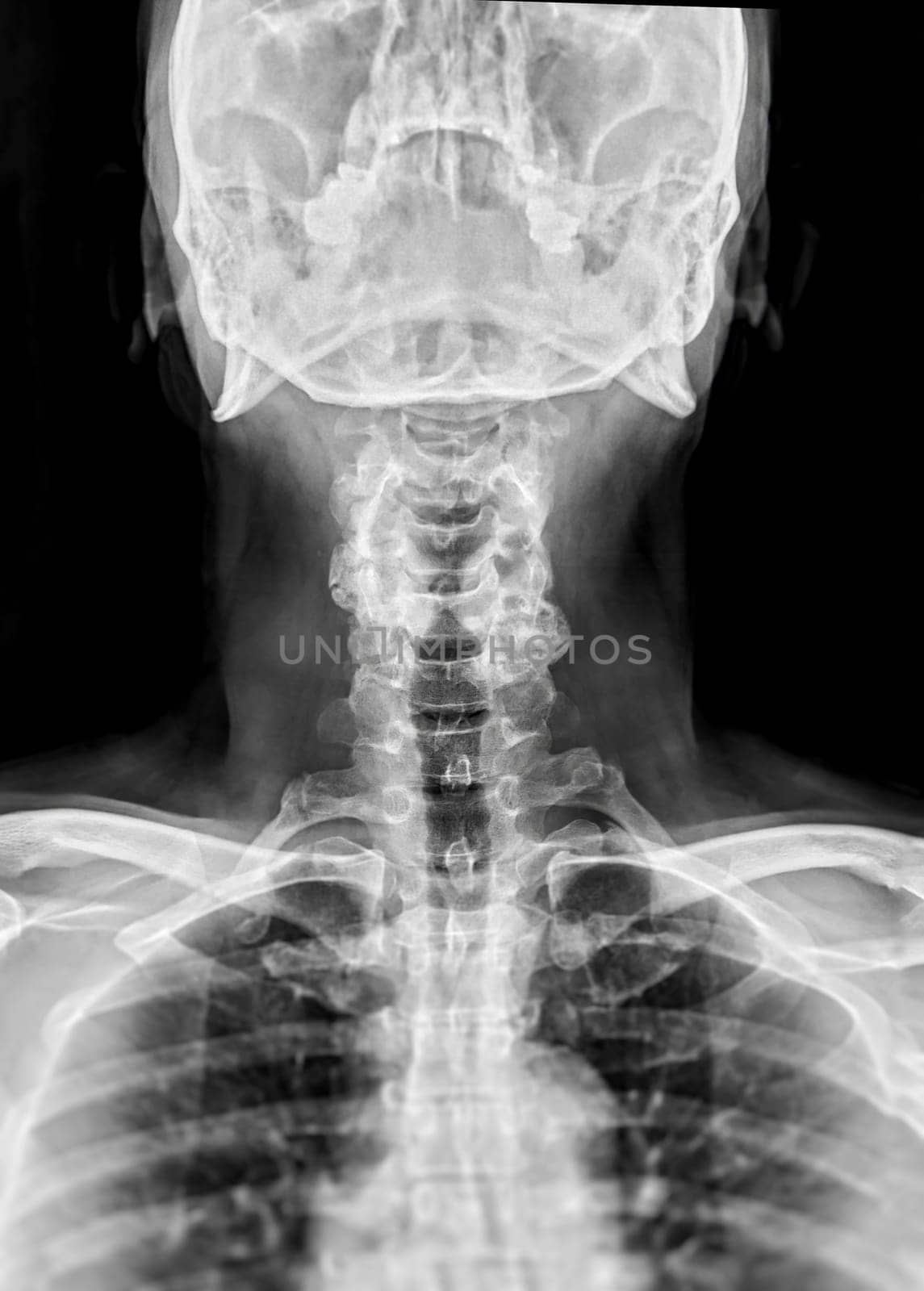 X-ray C-spine or x-ray image of Cervical spine lateral view for diagnostic intervertebral disc herniation ,Spondylosis and fracture. by samunella