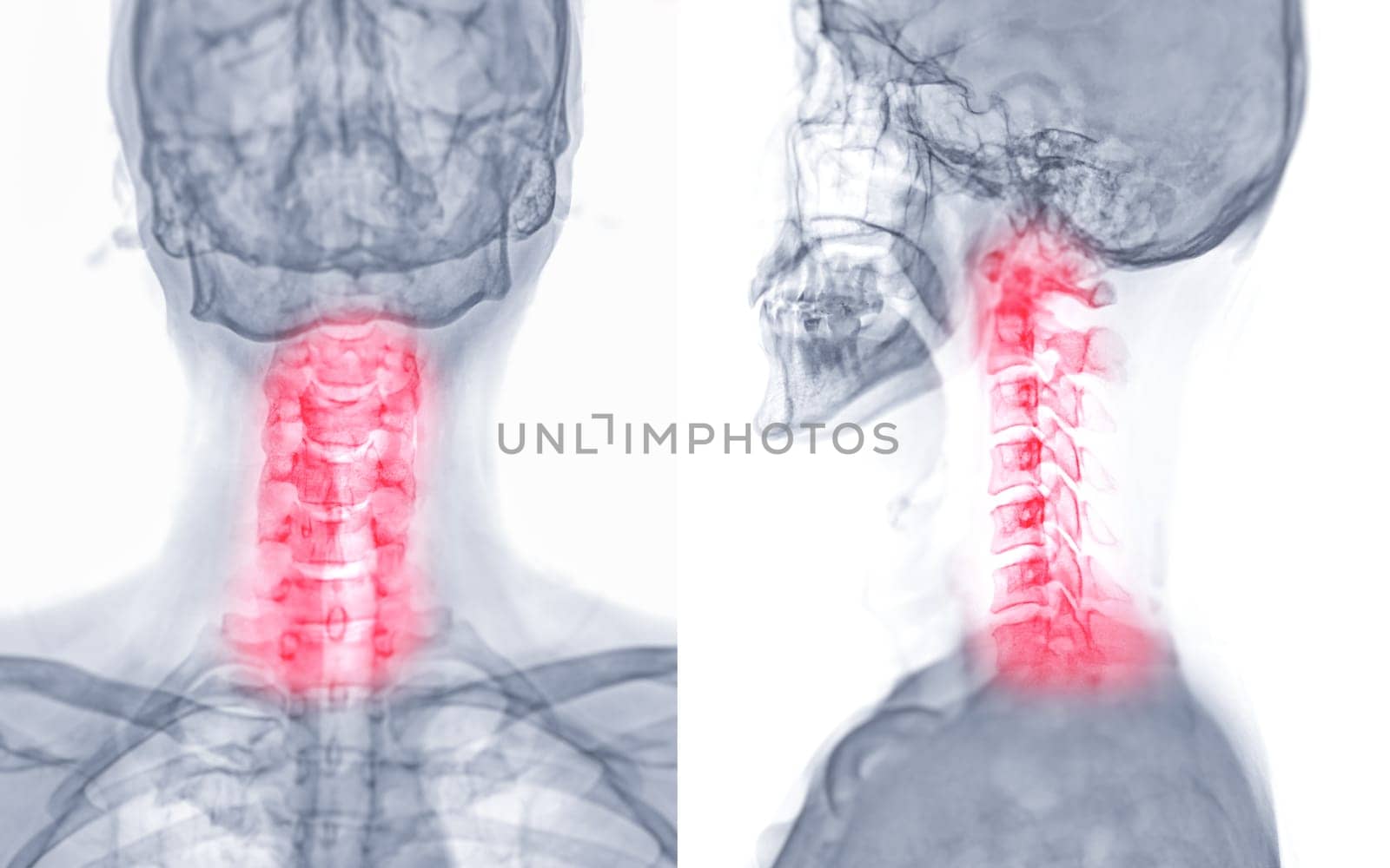 X-ray C-spine or x-ray image of Cervical spine AP and Lateral view for diagnostic intervertebral disc herniation ,Spondylosis and fracture.