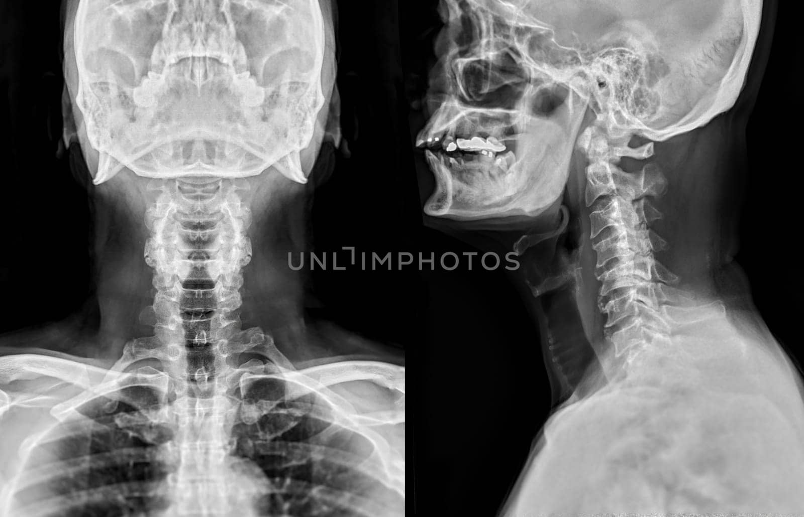 X-ray C-spine or x-ray image of Cervical spine AP and Lateral view for diagnostic intervertebral disc herniation ,Spondylosis and fracture. by samunella