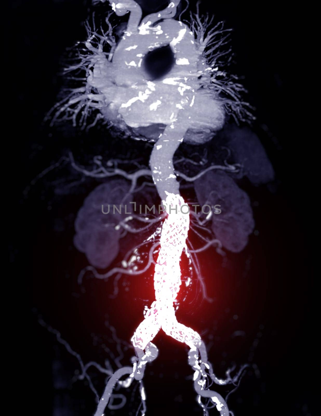 CTA whole aorta with Abdominal aorta stent graft 3D rendering image in case  abdominal aortic aneurysms. by samunella
