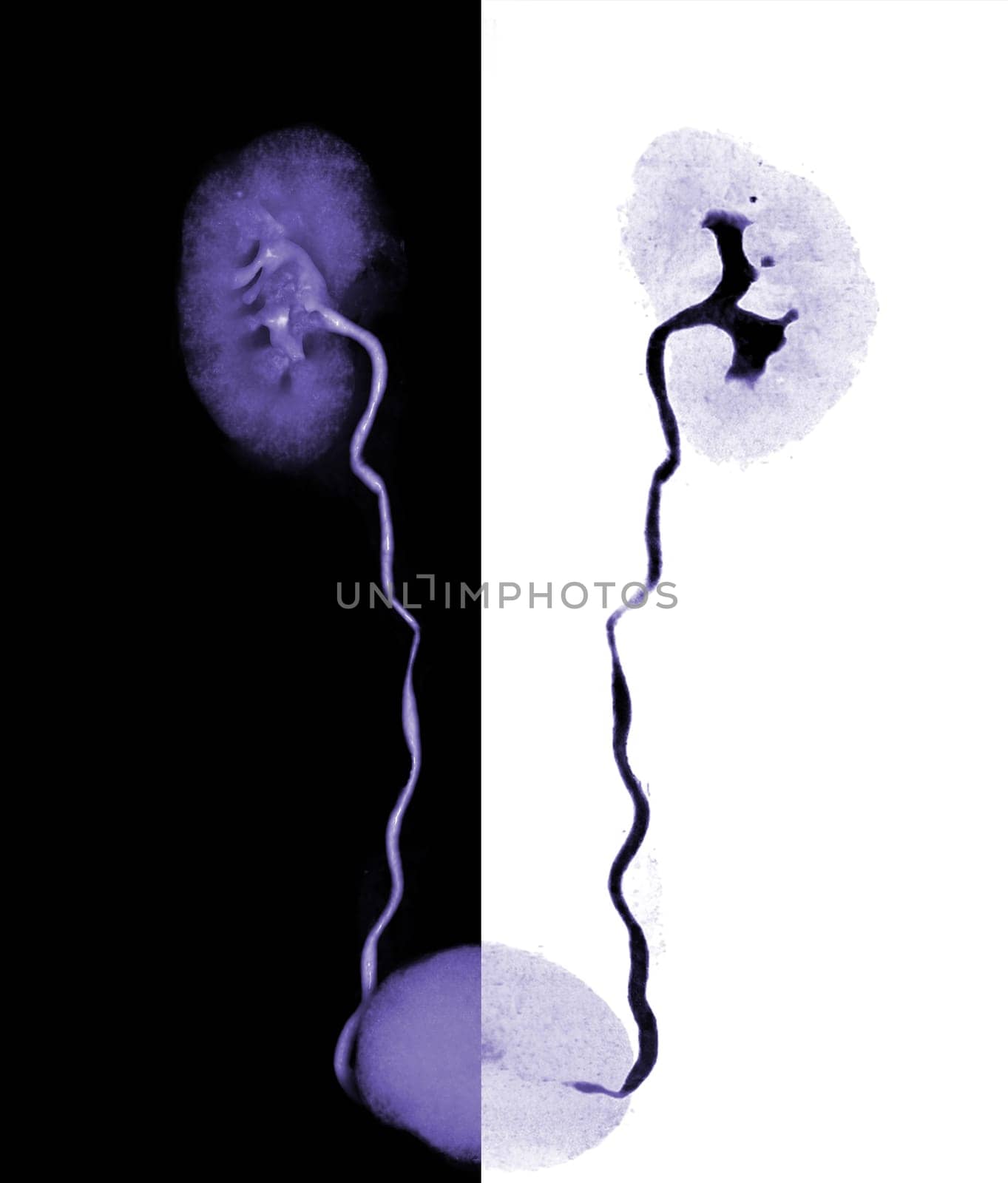 CTA Renal artery  3D rendering image  showing both kidney, Ureter and bladder .