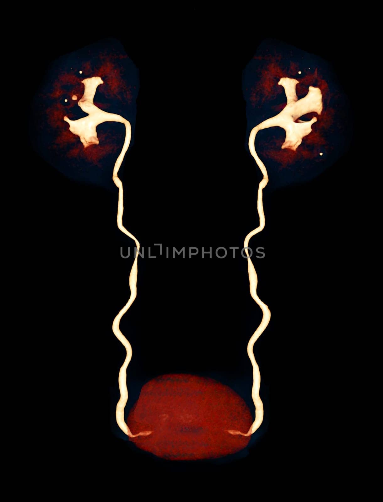 CTA Renal artery  3D rendering image  showing both kidney, Ureter and bladder . by samunella