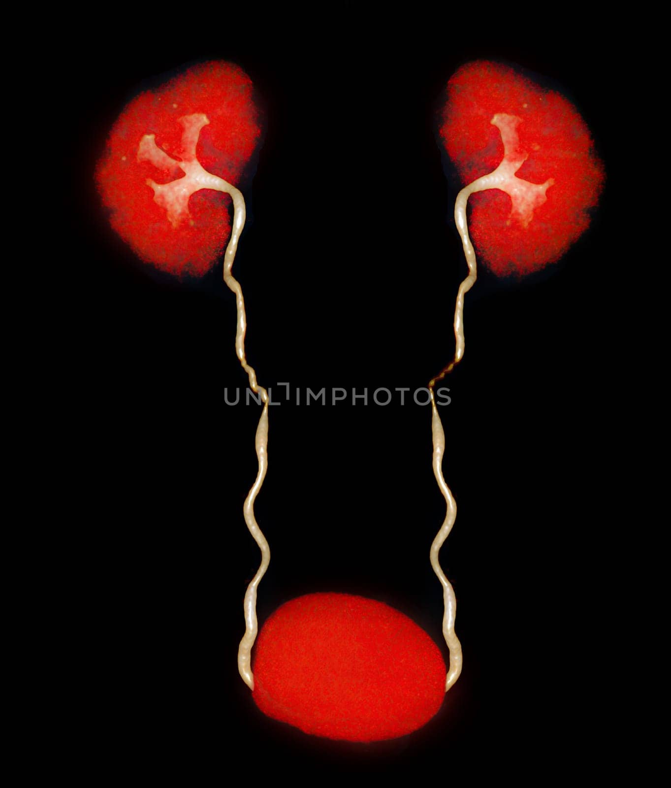 CTA Renal artery  3D rendering image  showing both kidney, Ureter and bladder .