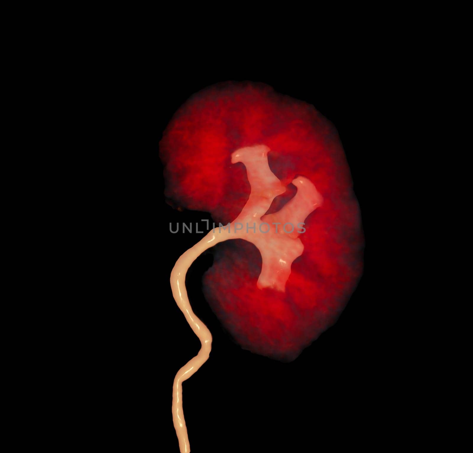 CTA Renal artery   showing kidney 3D rendering image.