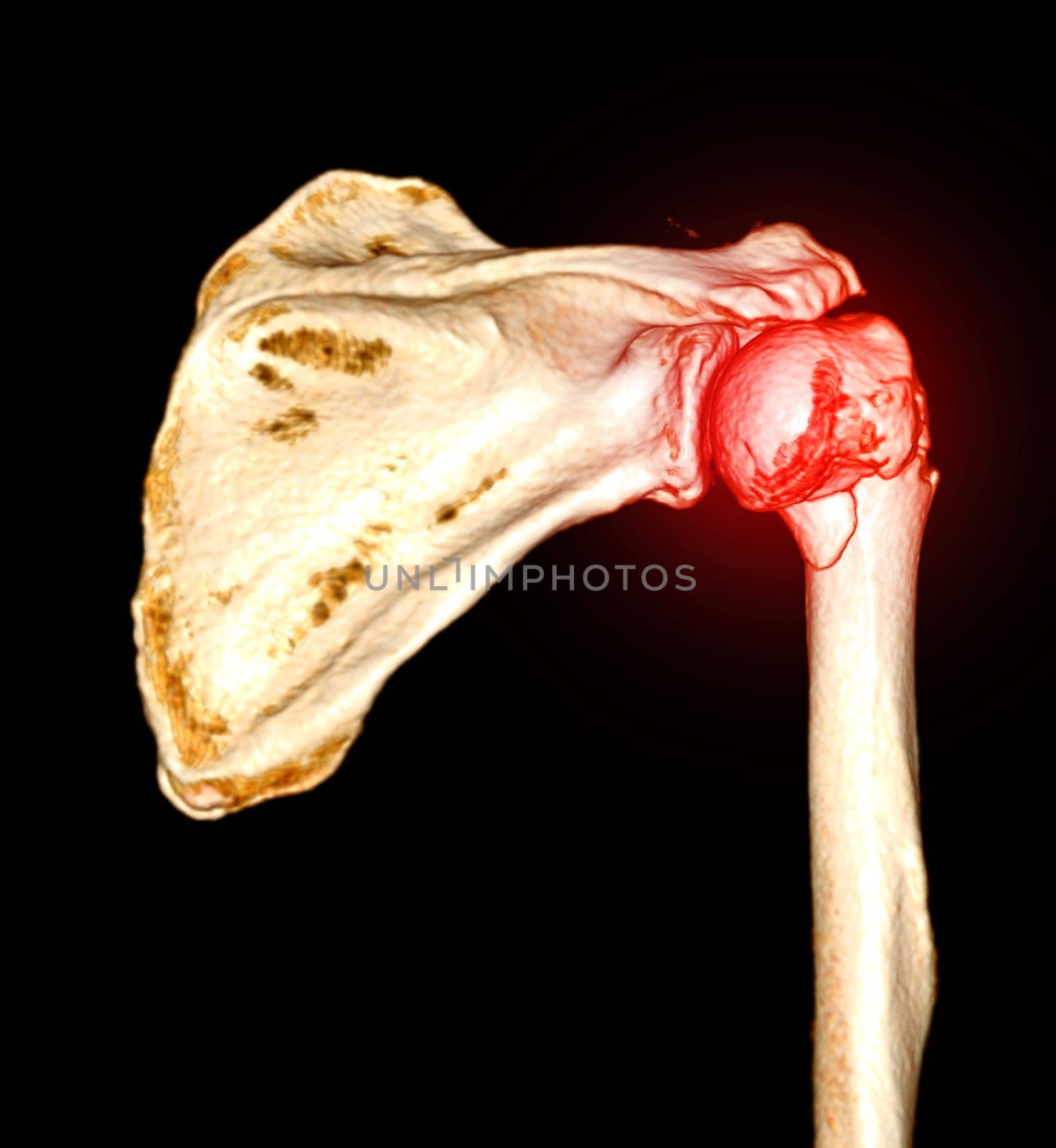 CT scan 3D rendering of Left shoulder showing fracture head of humerus . by samunella