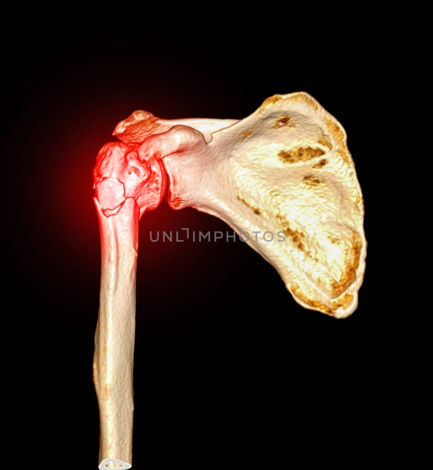 CT scan 3D rendering of Left shoulder showing fracture head of humerus .