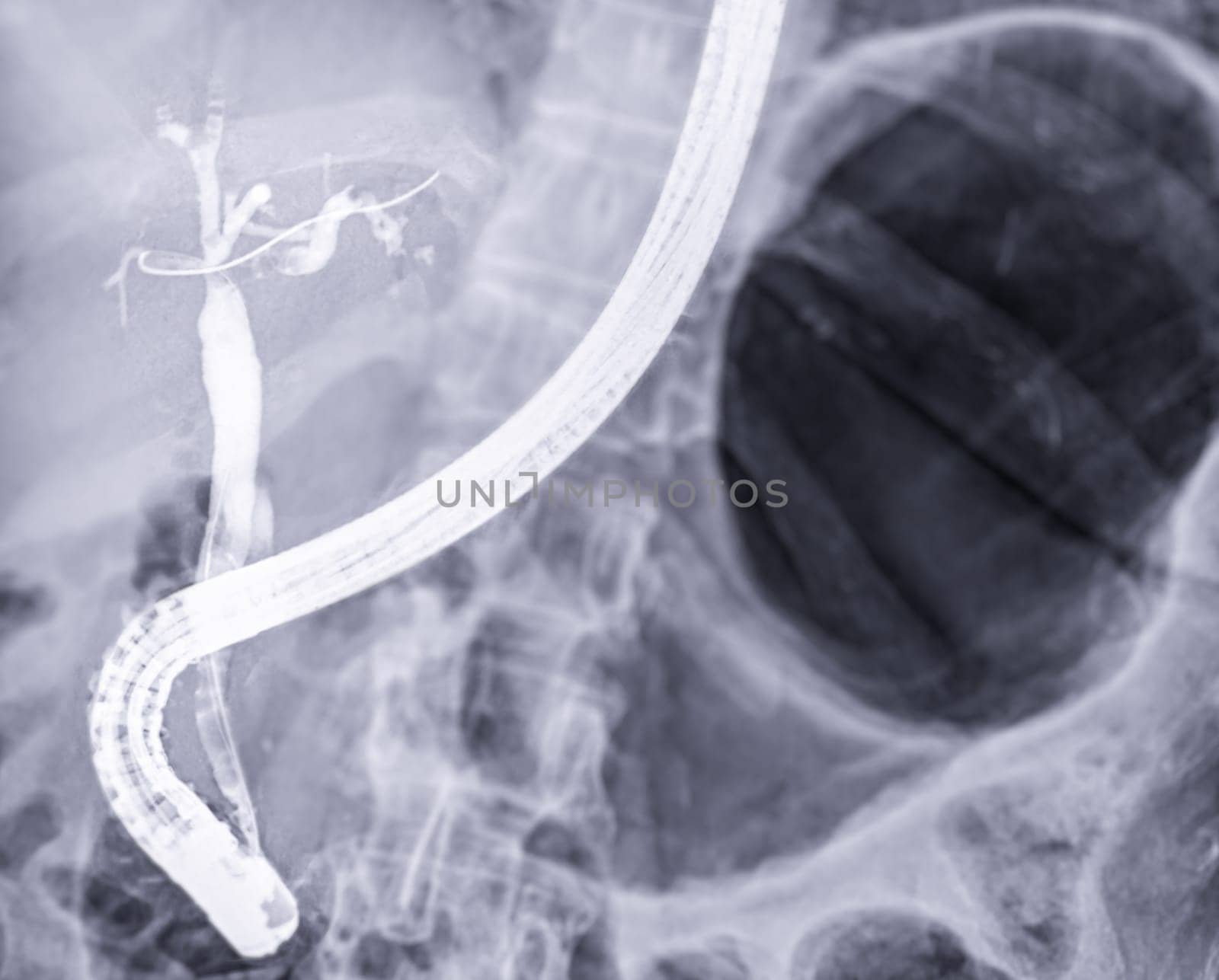 X-ray image of endoscopic after Doctor doing ERCP and laparoscopic cholecystectomy inside modern operating room.