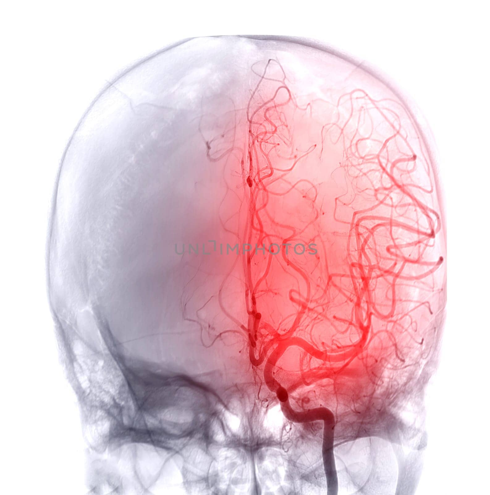 Cerebral angiography  image from Fluoroscopy in intervention radiology  showing cerebral artery. by samunella