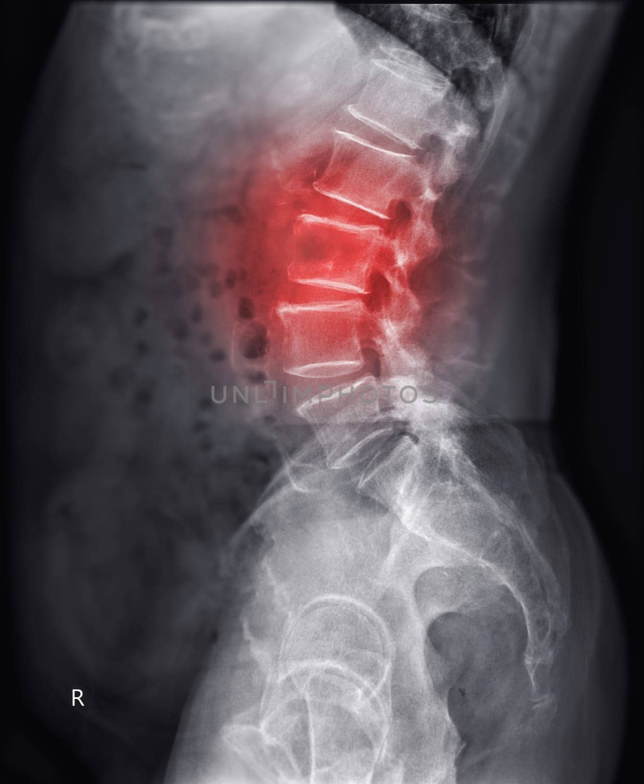 X-ray image of lambosacral spine or L-S spine showing lesion at L3. by samunella