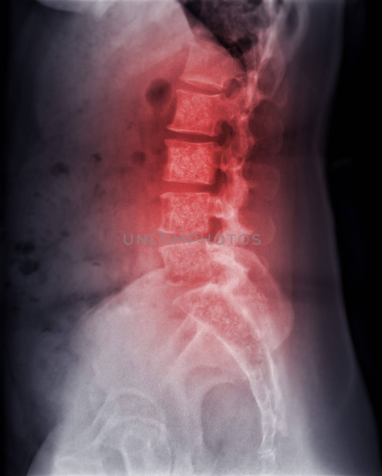 X-ray image of lambosacral spine or L-S spine showing Bone metastasis . by samunella