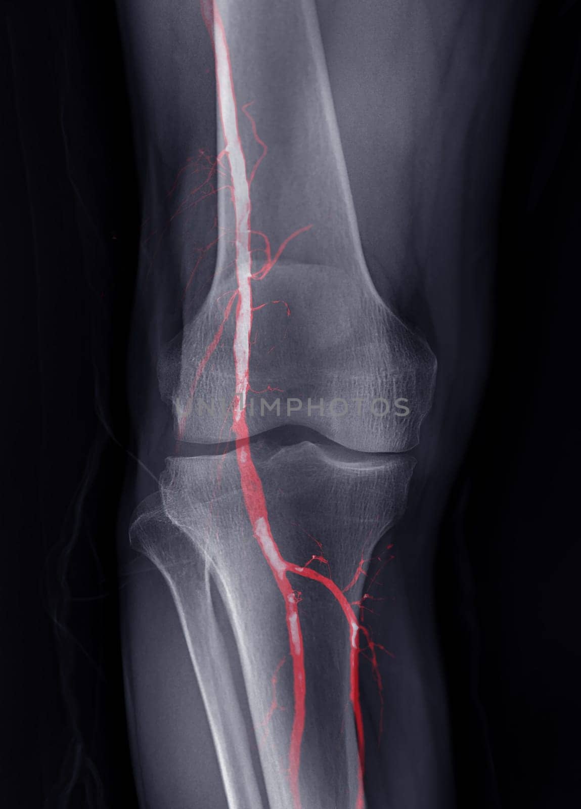 X-ray image of knee joint Fusion  with CTA Femoral run off .