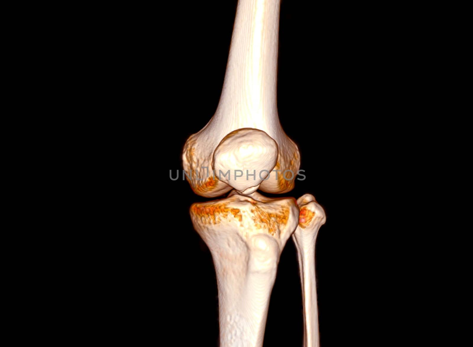 CT Scan of  Knee joint 3D rendering . by samunella