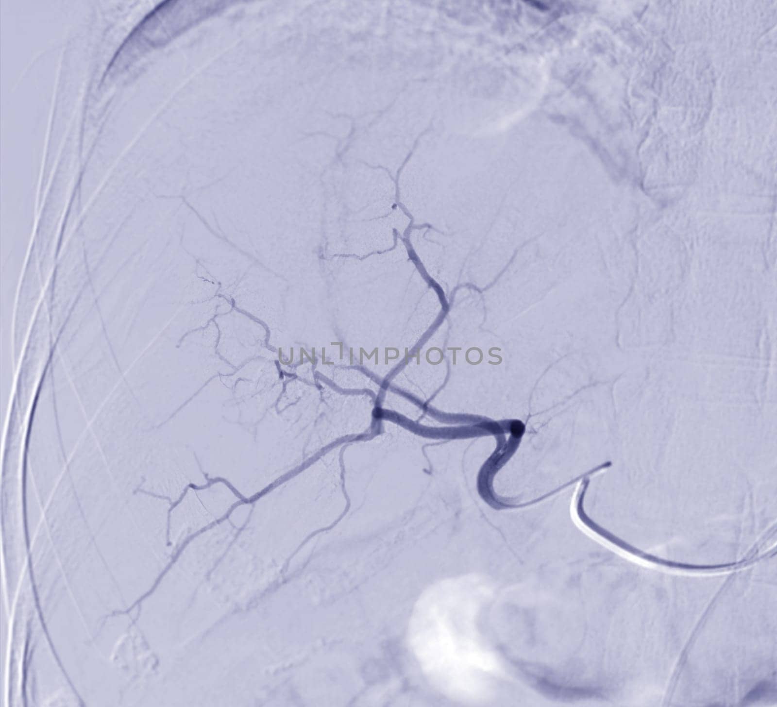 Imaging of TACE or Chemoembolization is a procedure that allows a dose of chemotherapy drugs to be administered directly to Liver tumor or HCC showing hepatic artery.