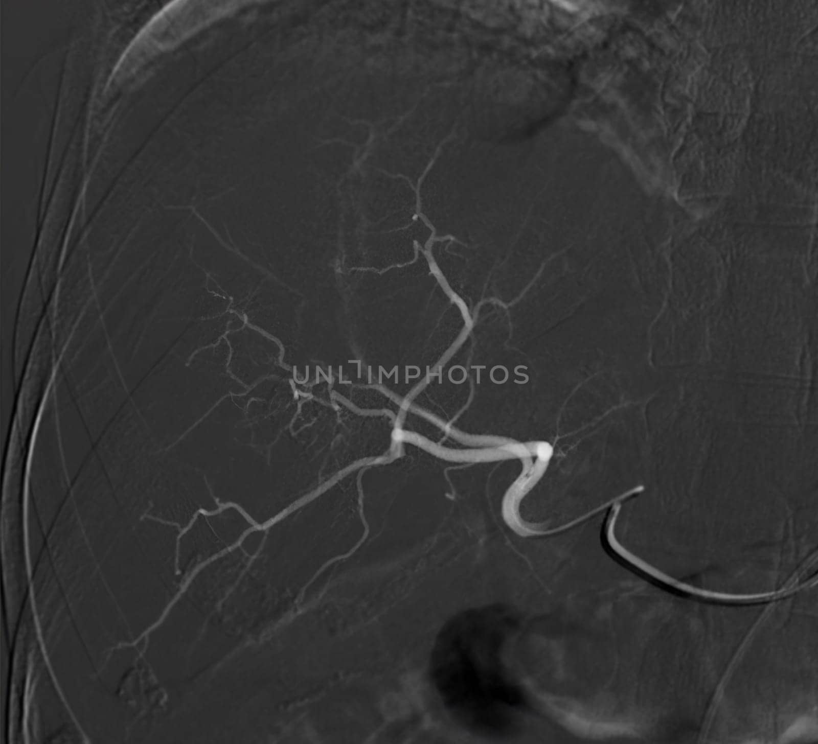 Imaging of TACE or Chemoembolization is a procedure that allows a dose of chemotherapy drugs to be administered directly to Liver tumor or HCC showing hepatic artery. by samunella
