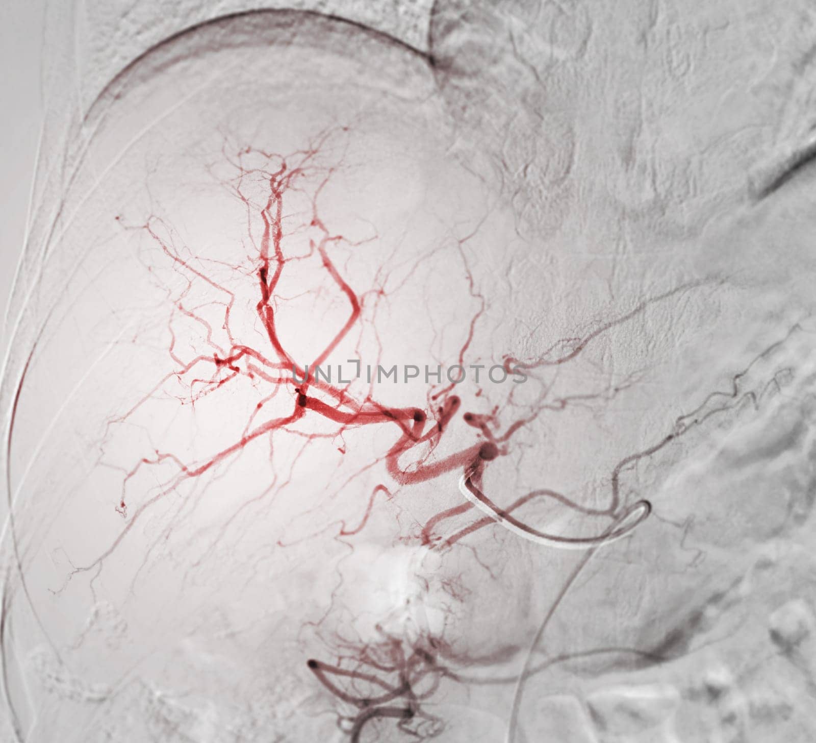 Imaging of TACE or Chemoembolization is a procedure that allows a dose of chemotherapy drugs to be administered directly to Liver tumor or HCC showing hepatic artery. by samunella