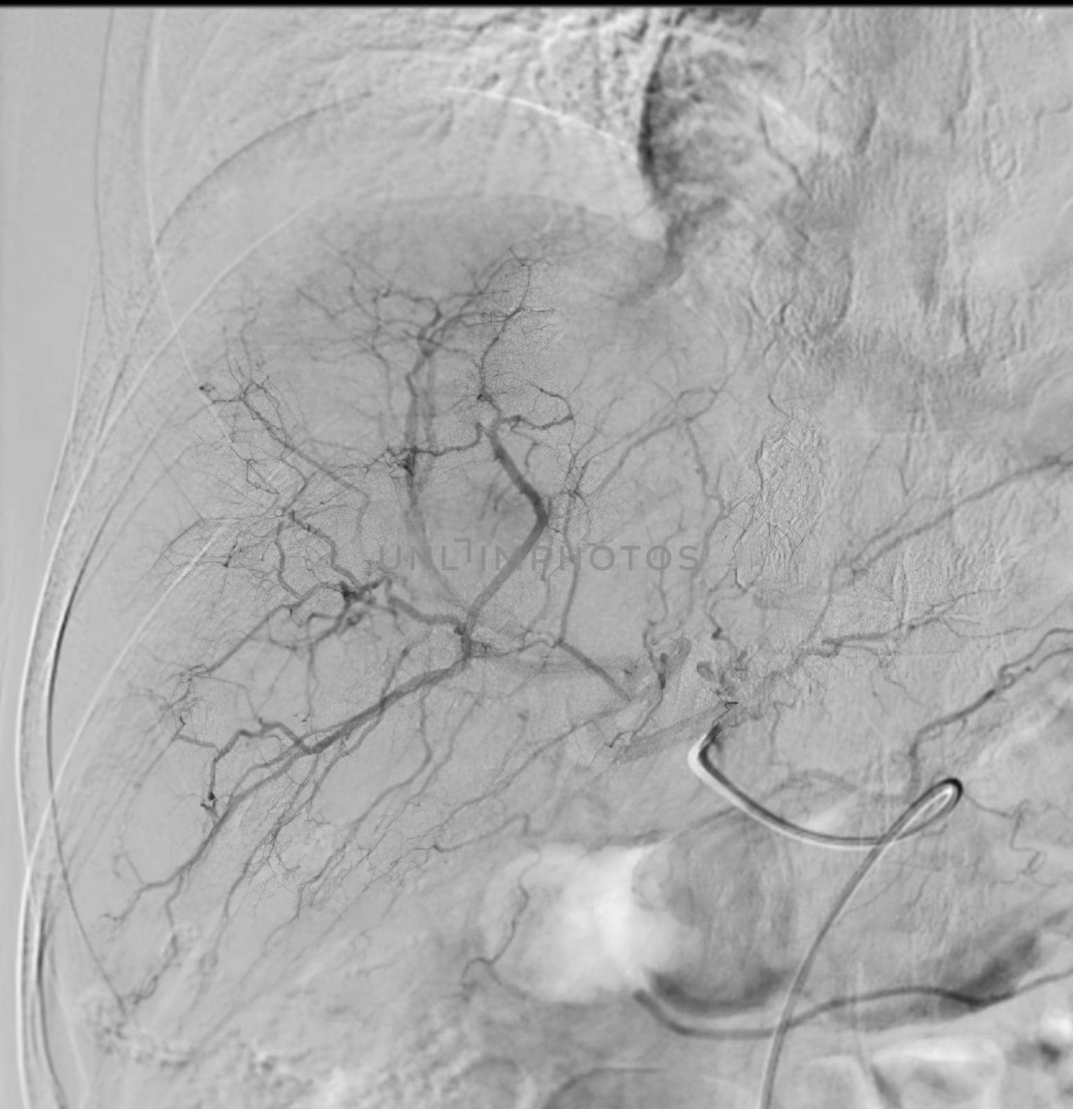 Imaging of TACE or Chemoembolization is a procedure that allows a dose of chemotherapy drugs to be administered directly to Liver tumor or HCC showing hepatic artery. by samunella