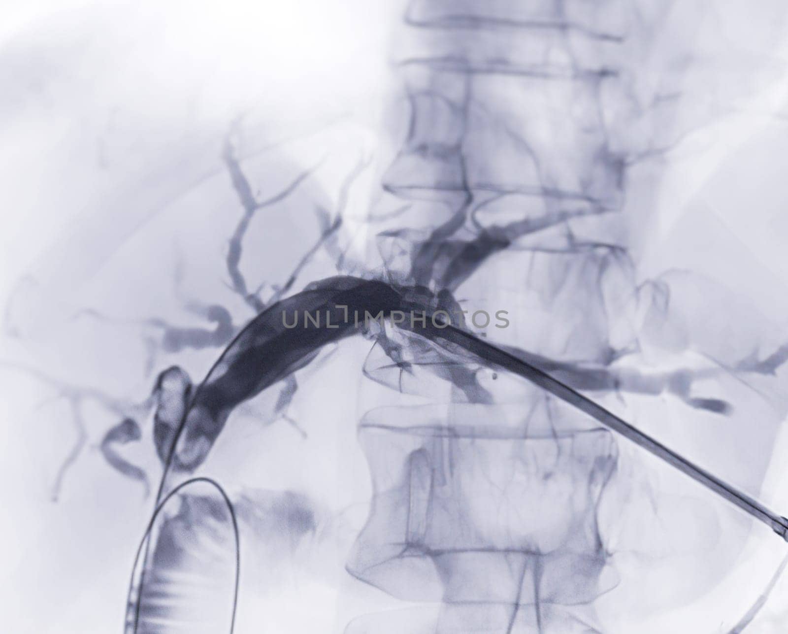 X-ray image of  portal vein  after Doctor doing ERCP and laparoscopic cholecystectomy inside modern operating room.