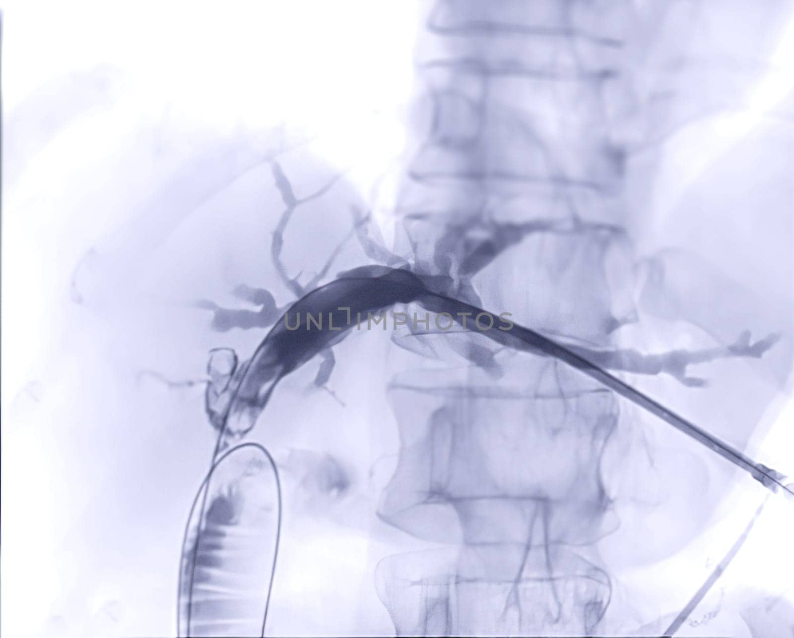 X-ray image of  portal vein  after Doctor doing ERCP and laparoscopic cholecystectomy inside modern operating room. by samunella