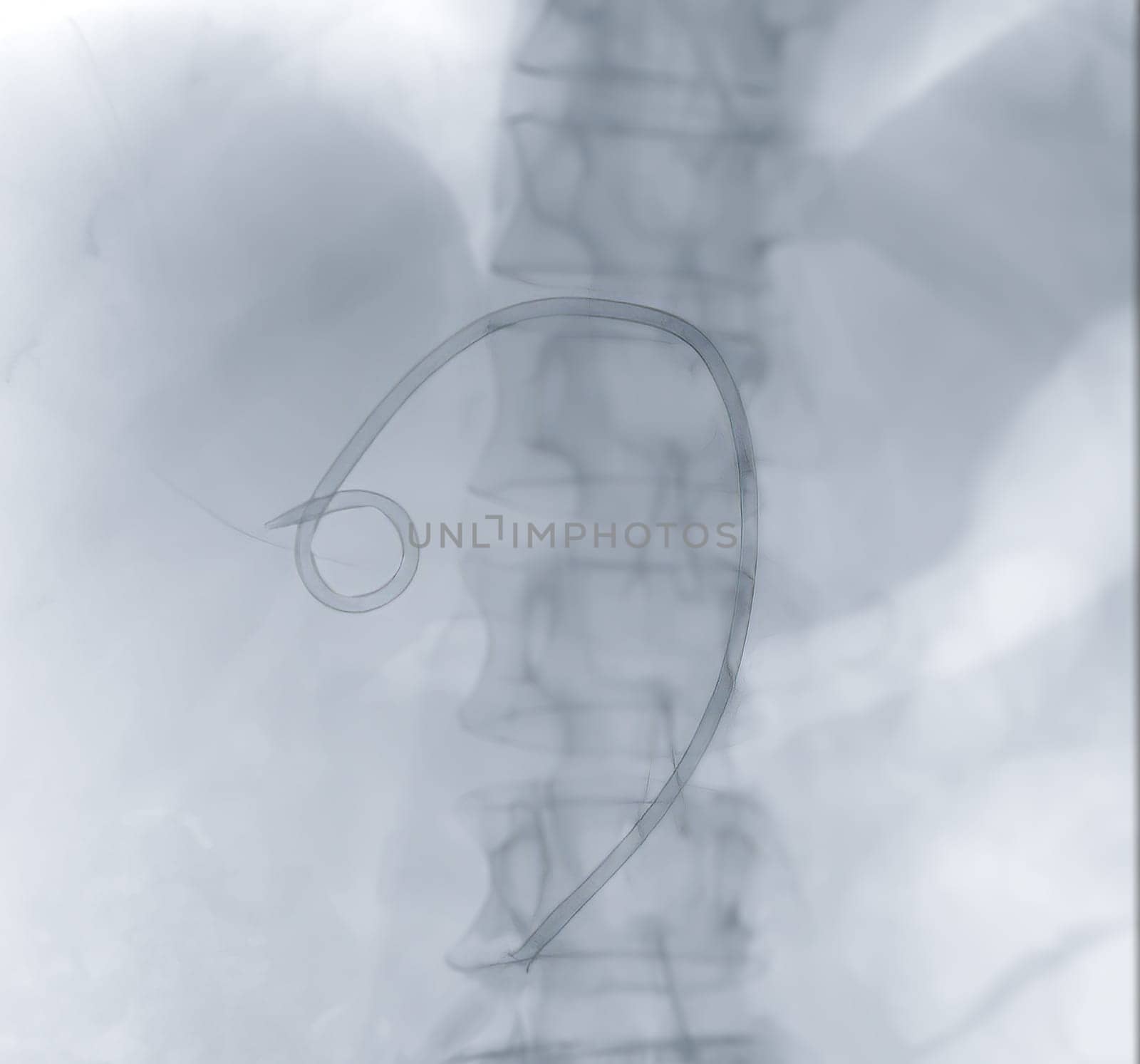X-ray image of catheter in Upper abdomen. by samunella