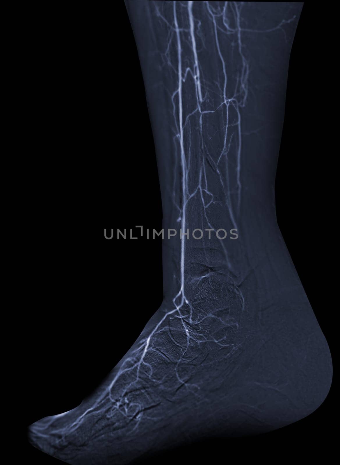Femoral artery angiogram or angiography  at lower extremity area. by samunella