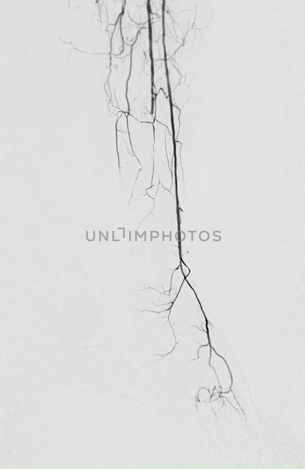 Femoral artery angiogram or angiography  at lower extremity area. by samunella