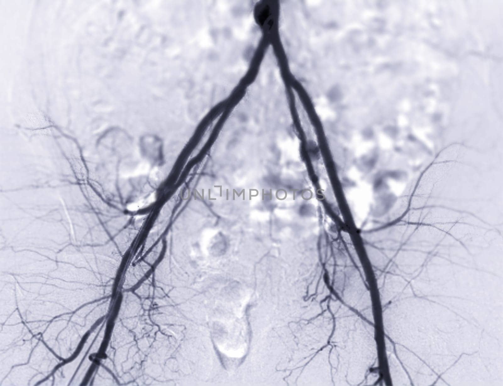 Femoral artery angiogram or angiography  by samunella