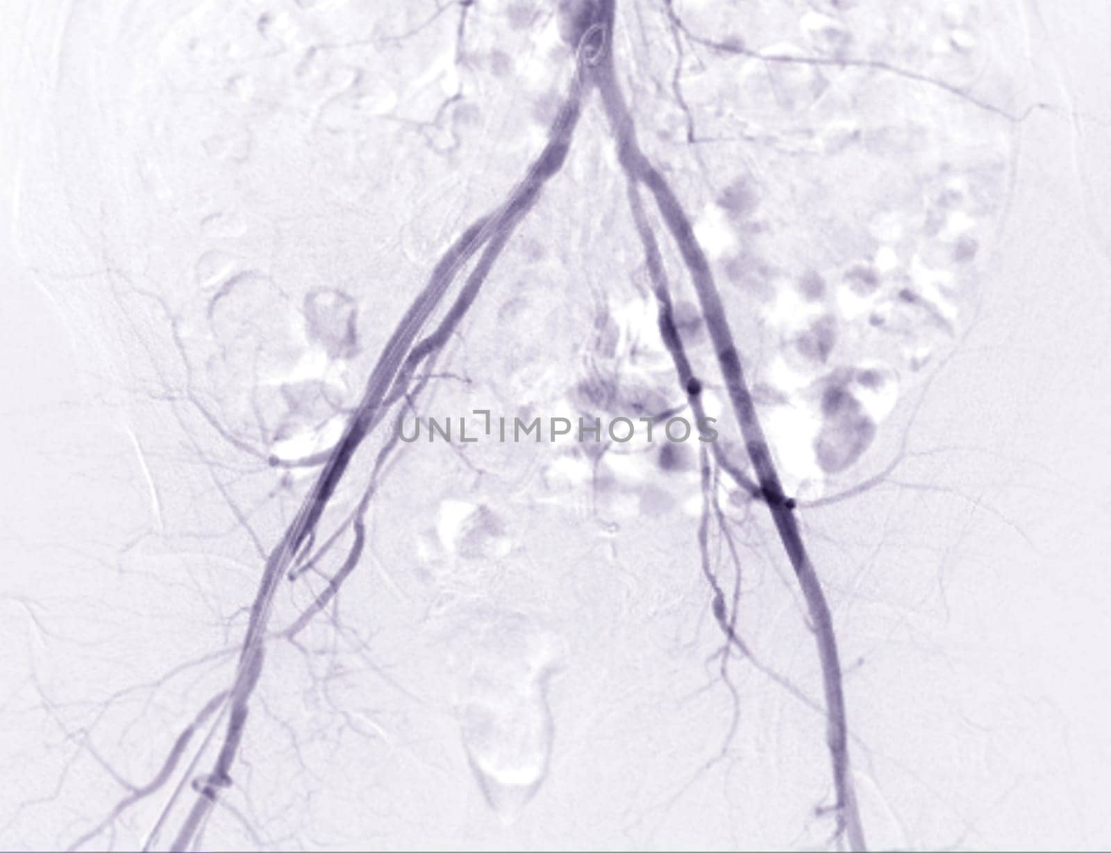 Femoral artery angiogram or angiography  by samunella