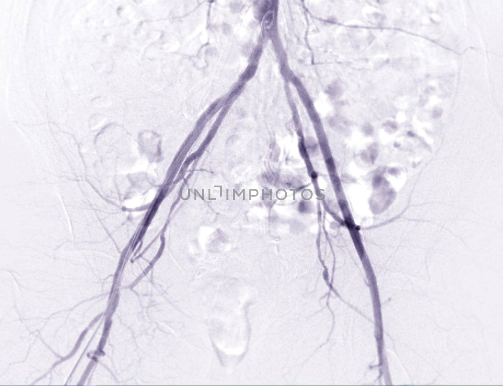 Femoral artery angiogram or angiography 