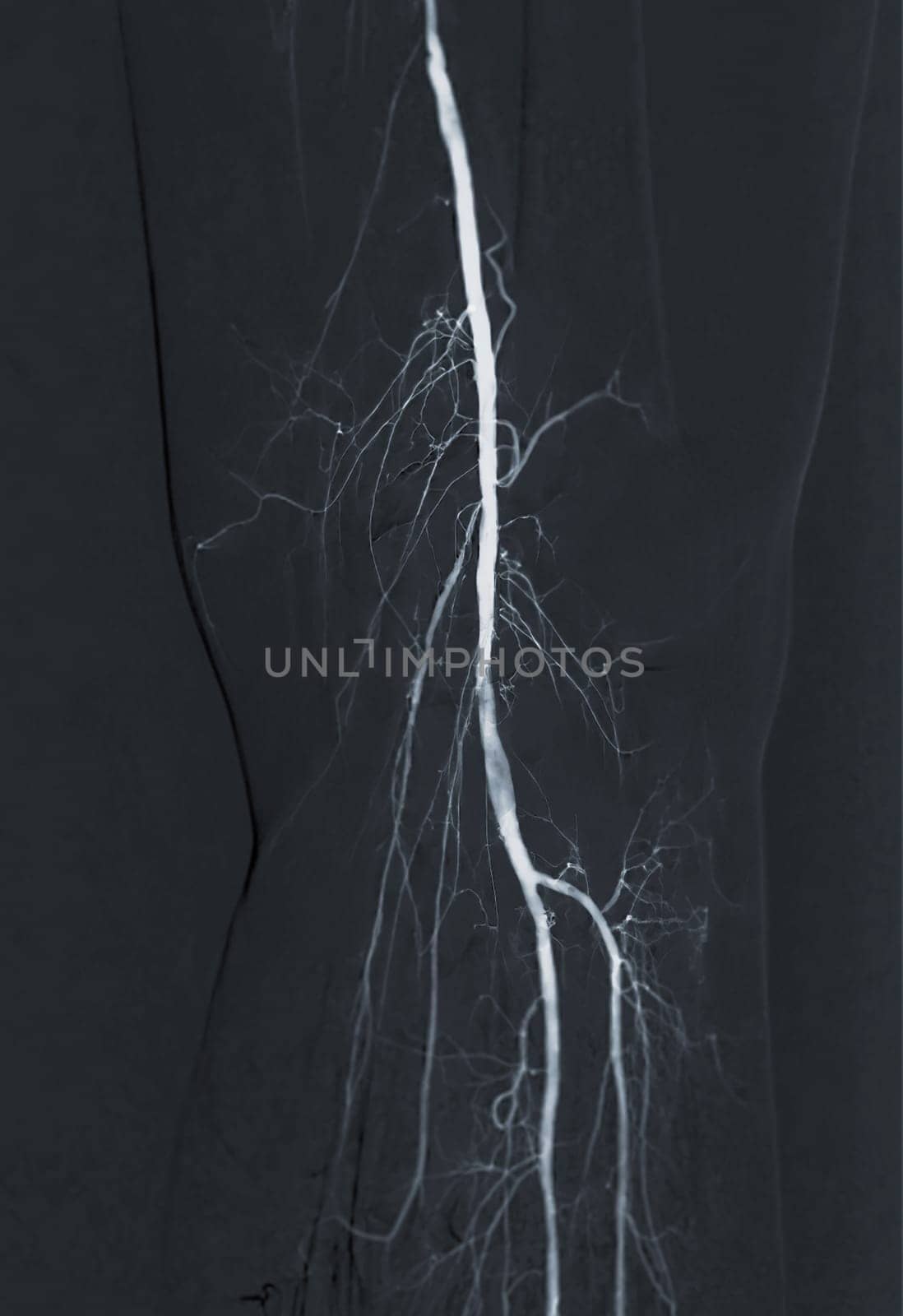 Femoral artery angiogram or angiography 