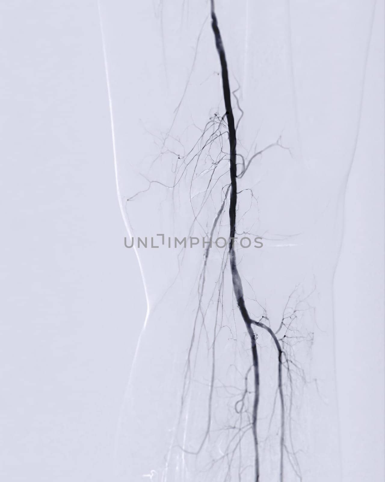 Femoral artery angiogram or angiography  by samunella