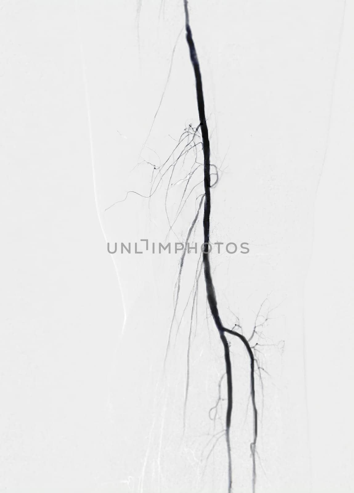 Femoral artery angiogram or angiography 