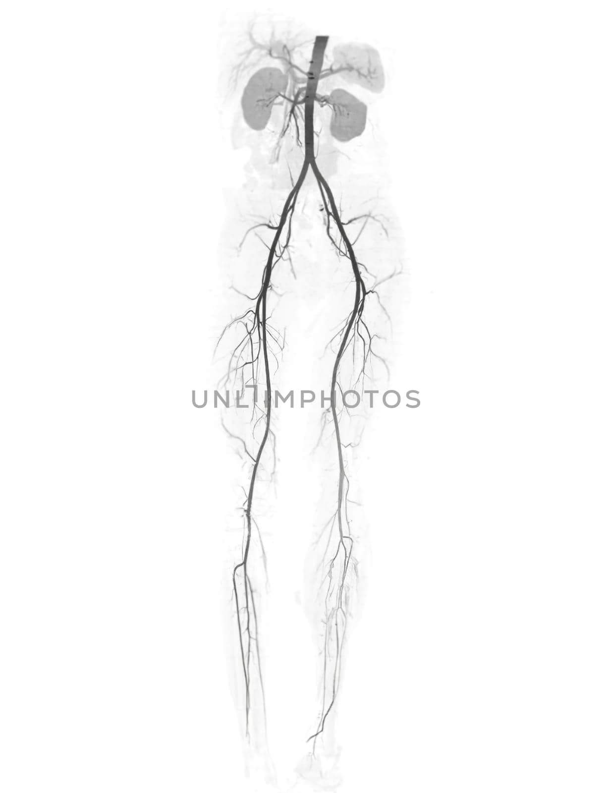 CTA femoral artery run off showing  femoral artery for diagnostic  Acute or Chronic Peripheral Arterial Disease. by samunella