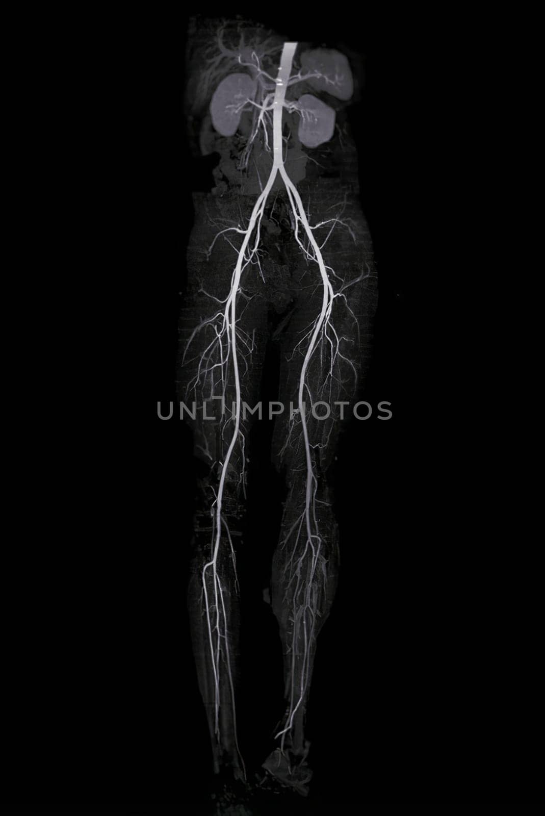 CTA femoral artery run off showing  femoral artery for diagnostic  Acute or Chronic Peripheral Arterial Disease. by samunella