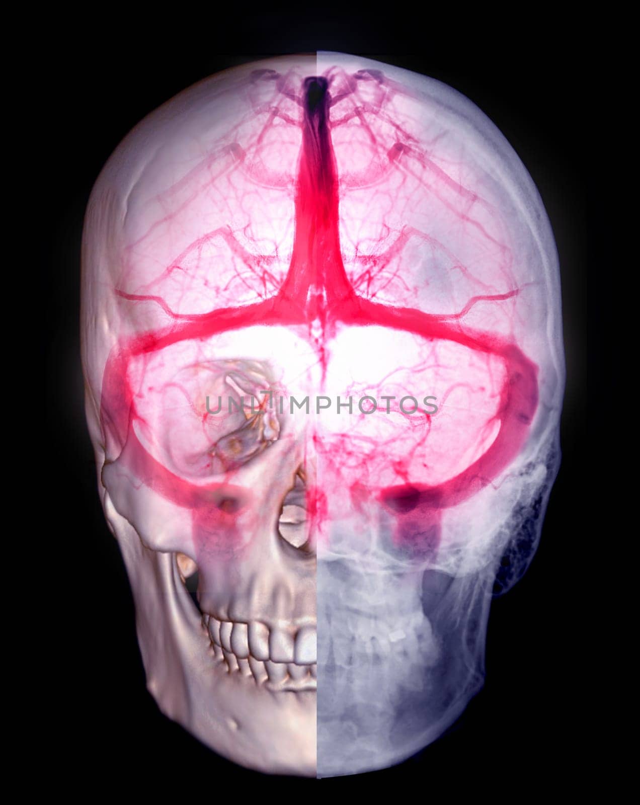 Cerebral  Venograpgy for diagnosisi Cerebral Venous Thrombosis