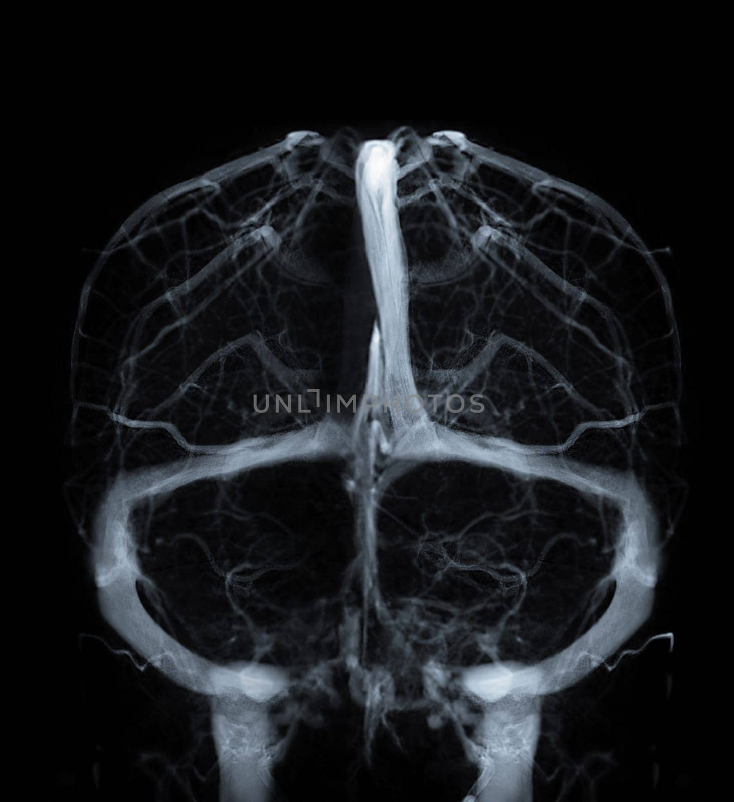 Cerebral  Venograpgy for diagnosisi Cerebral Venous Thrombosis