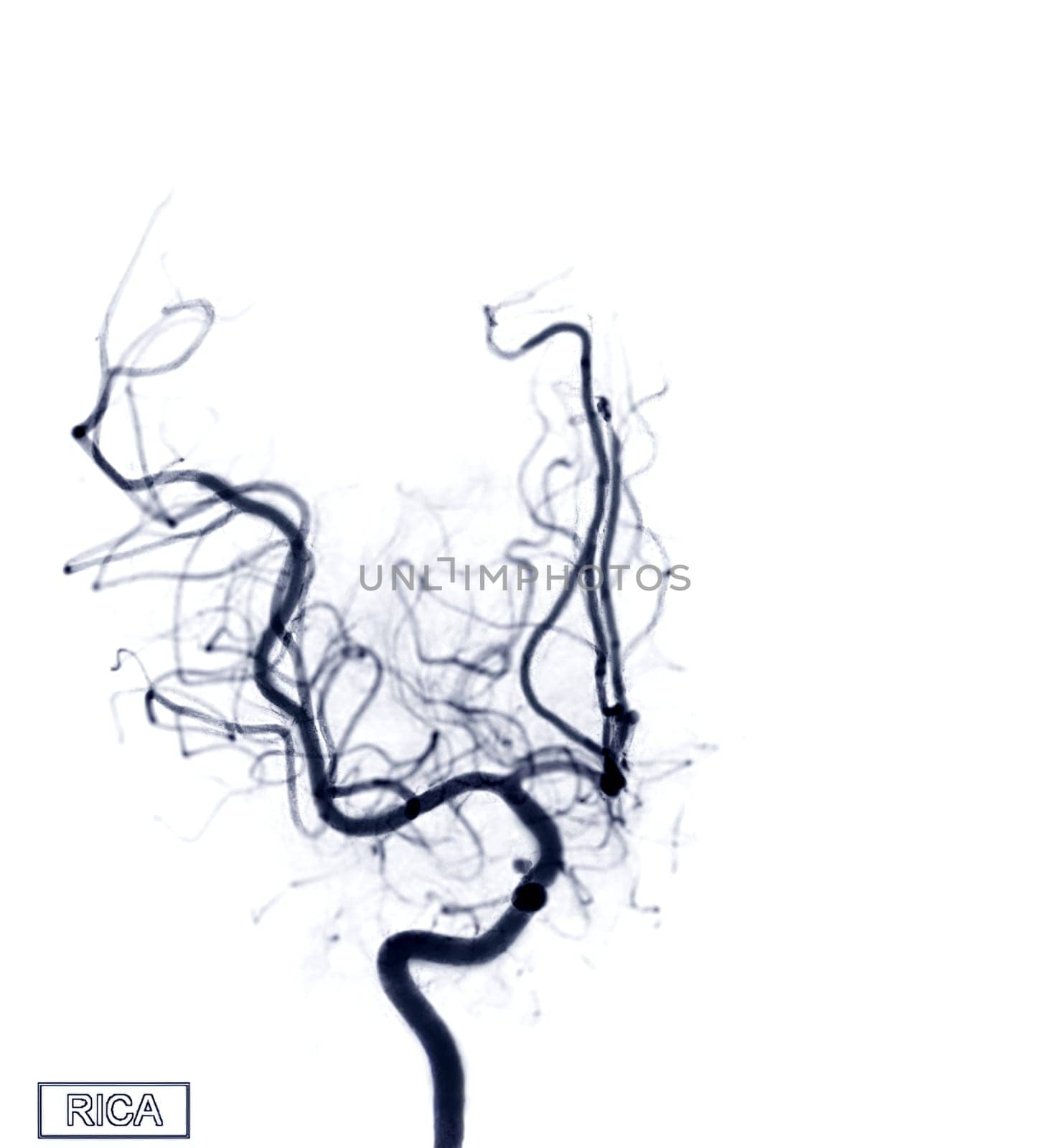 Cerebral angiography  image of RICA from Fluoroscopy in intervention radiology  showing cerebral artery.