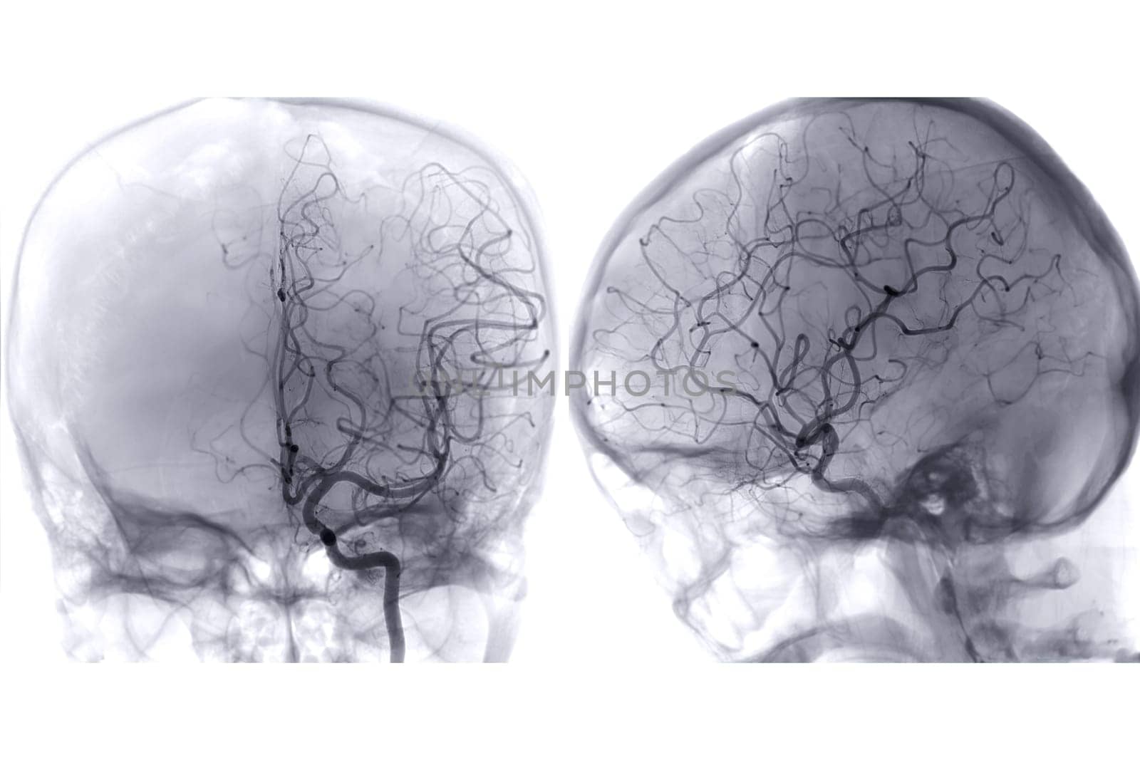 Cerebral angiography  image from Fluoroscopy in intervention radiology  showing cerebral artery. by samunella
