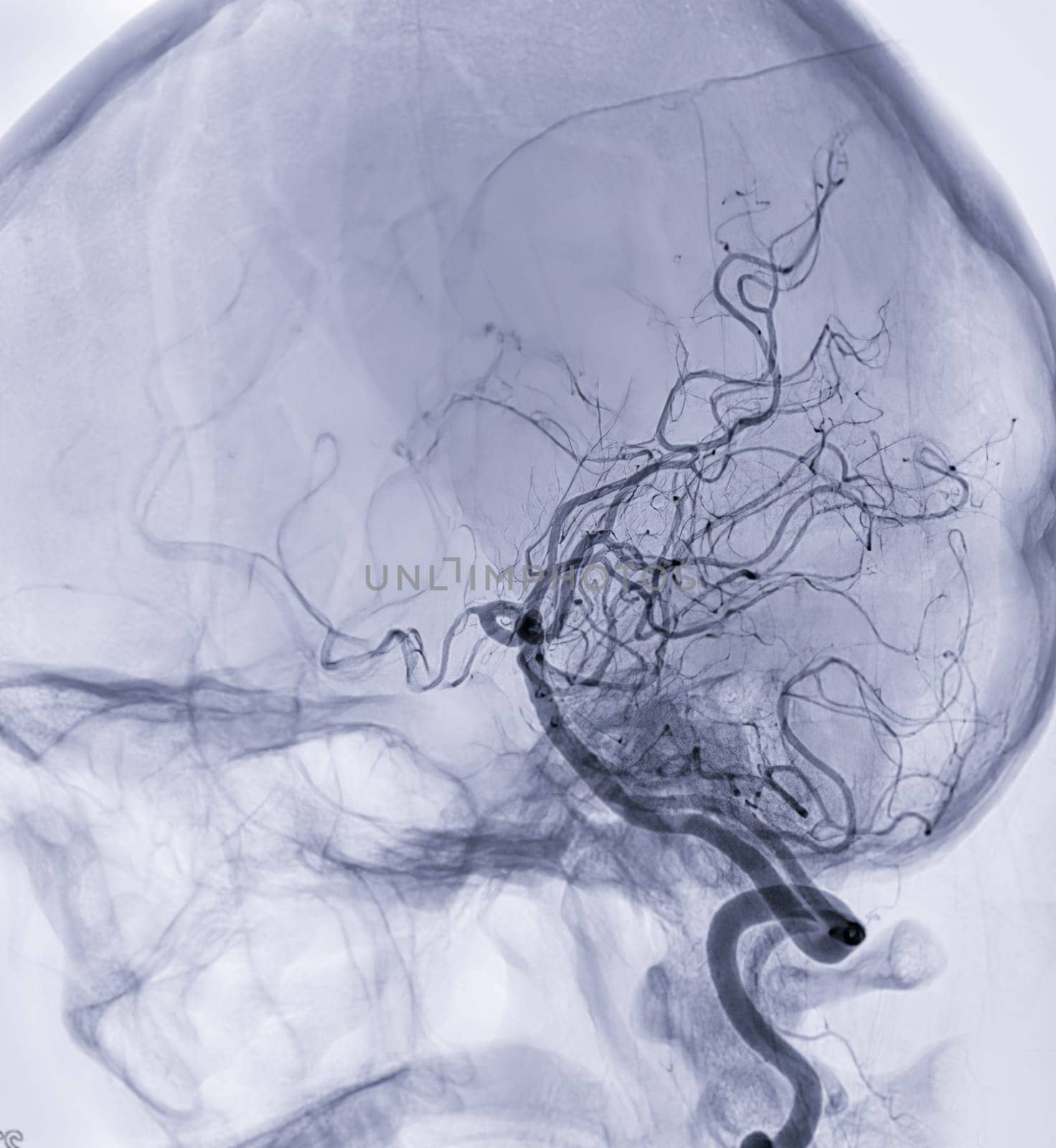 Cerebral angiography  imageor potesterior cerebral artery from Fluoroscopy in intervention radiology  showing cerebral artery. by samunella