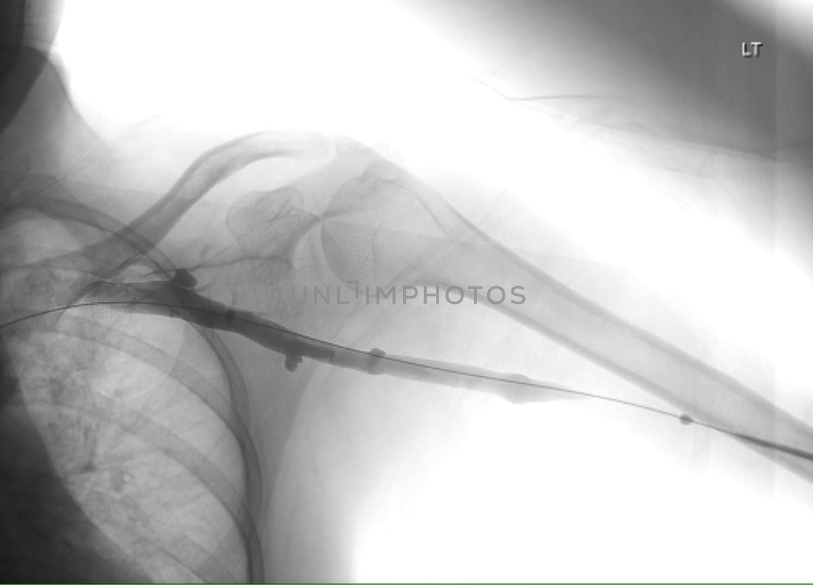 Image of Angioplasty, balloon angioplasty and percutaneous transluminal angioplasty (PTA) .