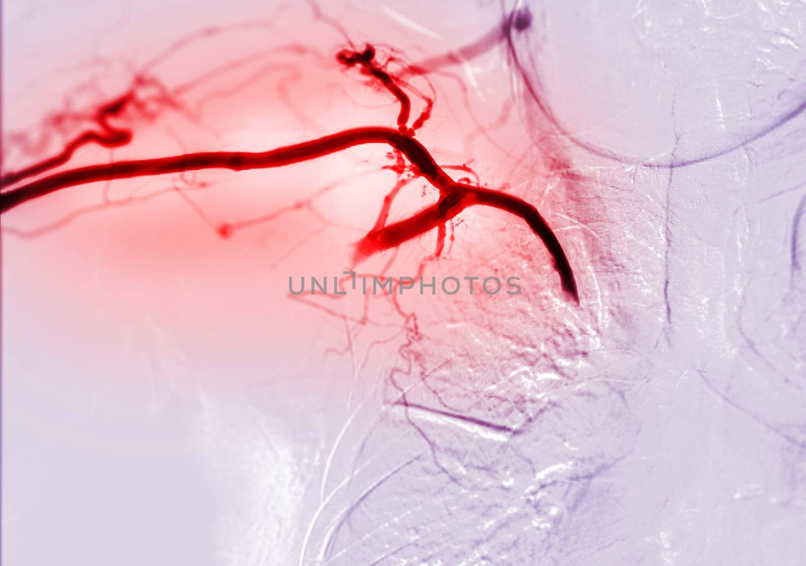Image of Angioplasty, balloon angioplasty and percutaneous transluminal angioplasty (PTA) .
