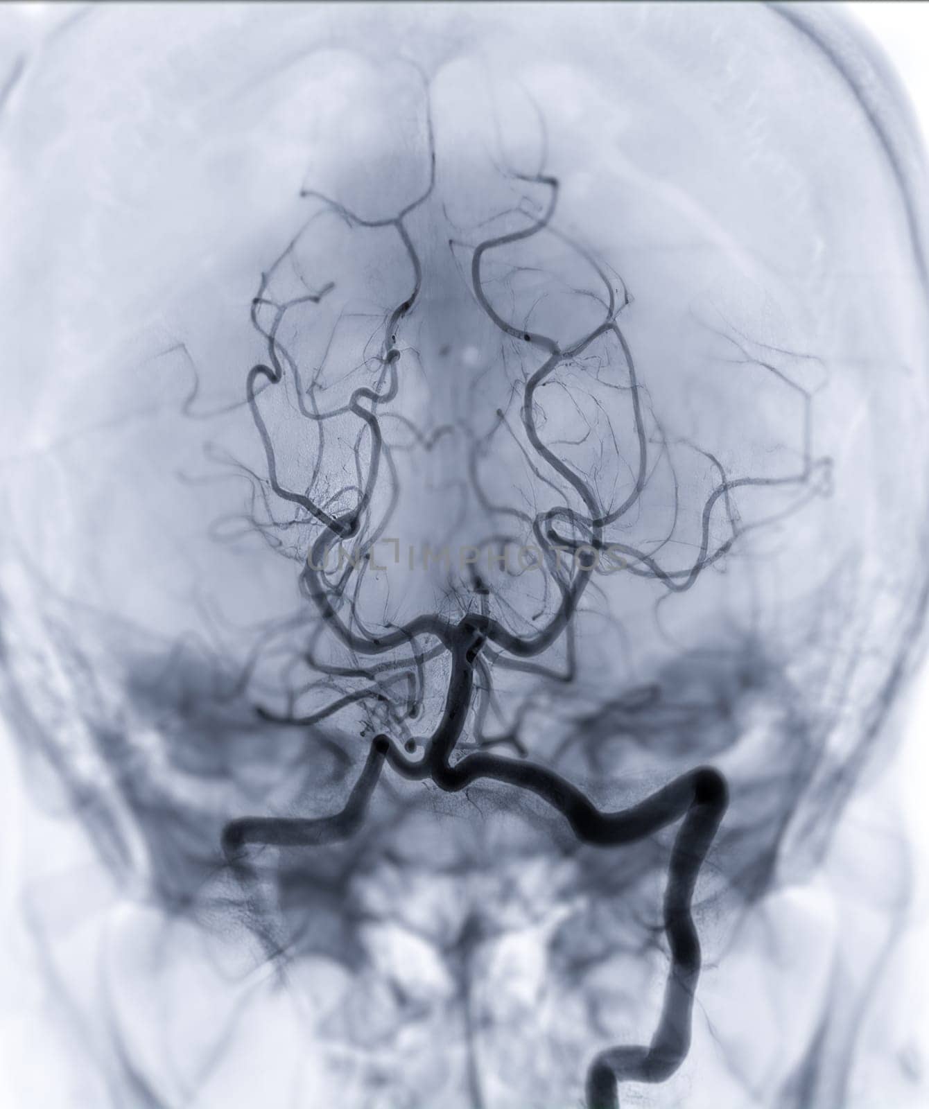 Cerebral angiography  imageor potesterior cerebral artery from Fluoroscopy in intervention radiology  showing Basilar artery. by samunella