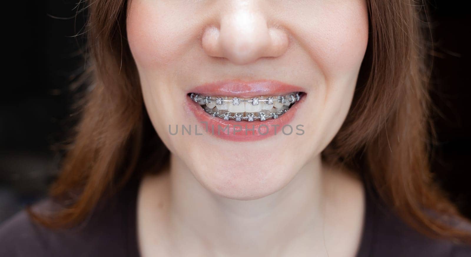 The smile of a young girl with braces on her white teeth. by AnatoliiFoto